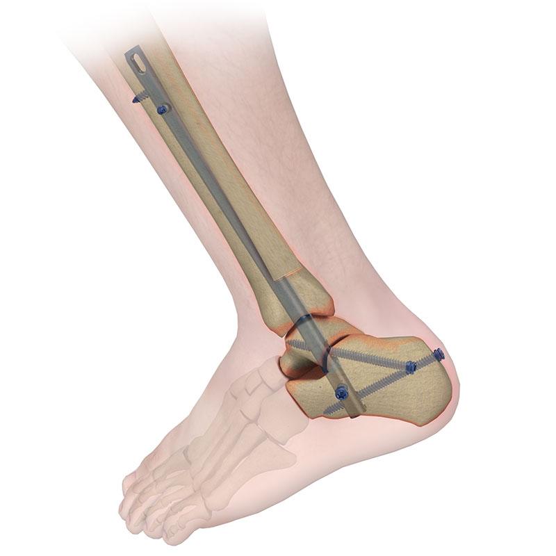 Ретроградний стержень для інтрамедулярного остеосинтезу великогомілкової кістки Charfix2